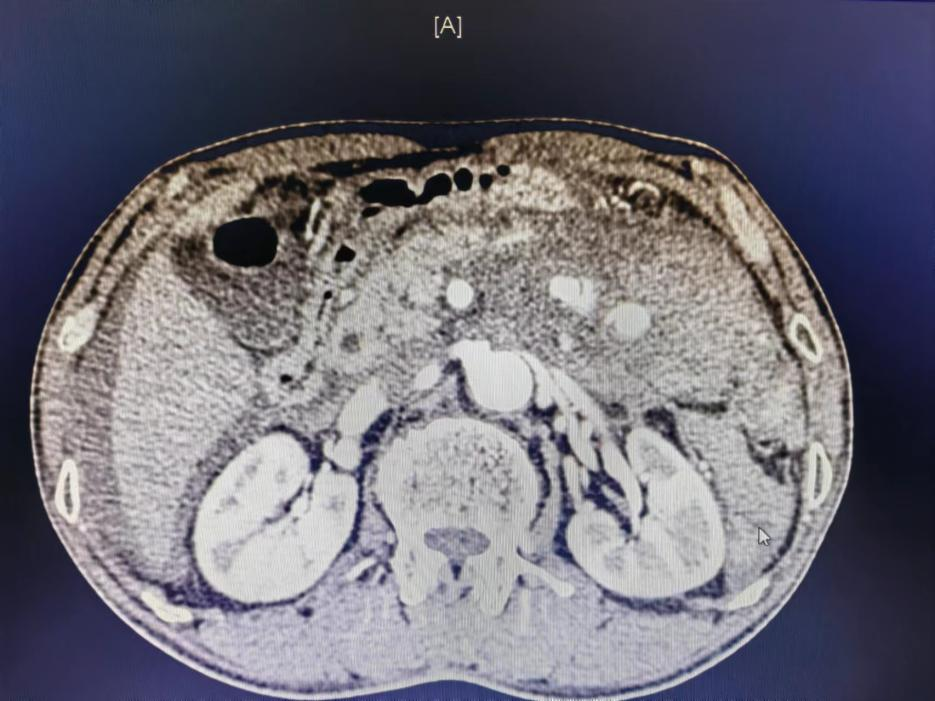 腹腔出血ct图片图片